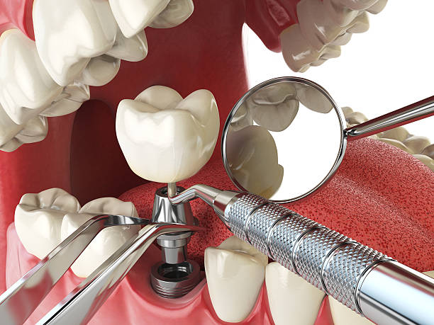 Best Emergency Wisdom Teeth Removal in Green, OH